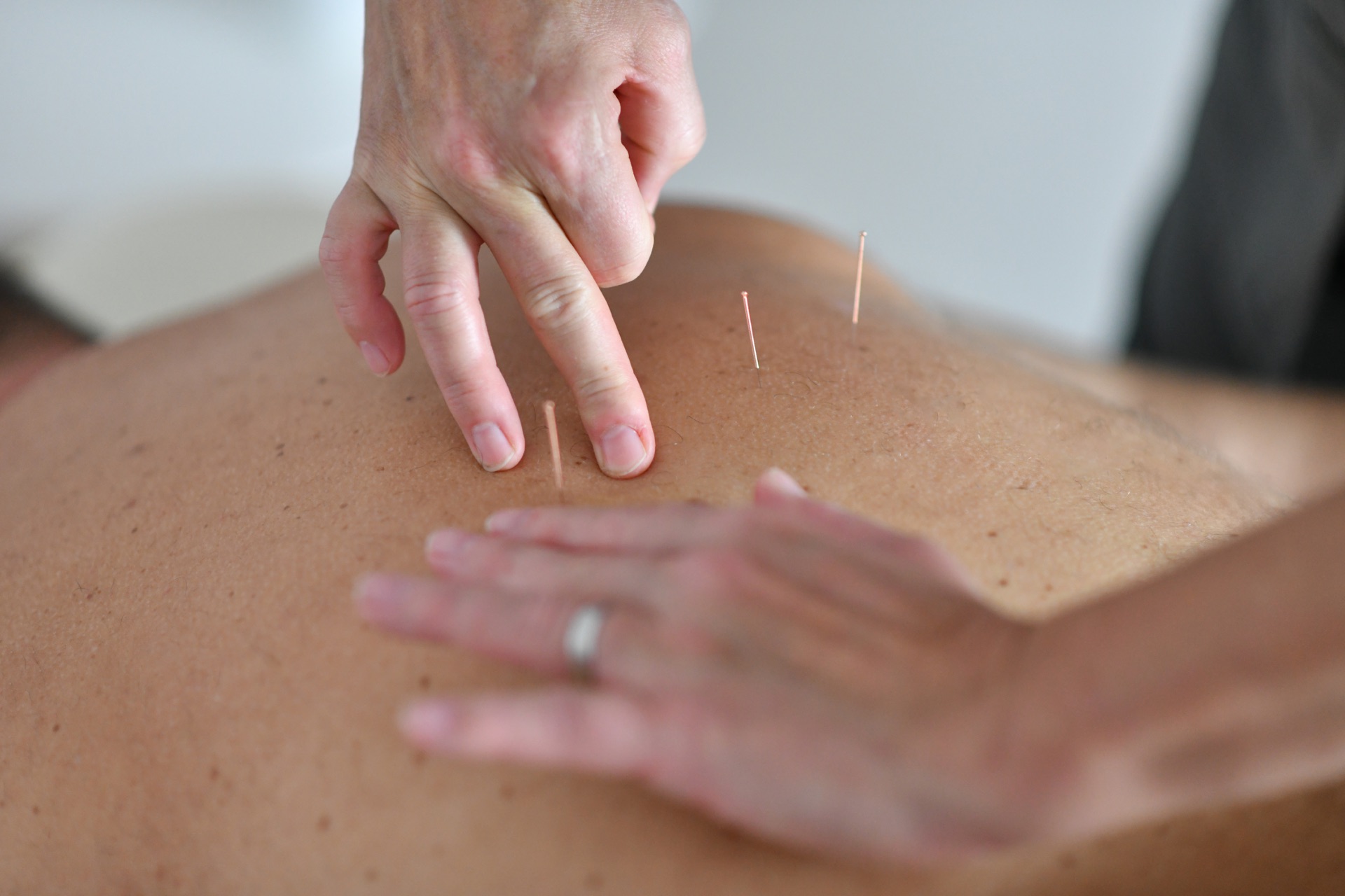 Akupunktúra - liečba